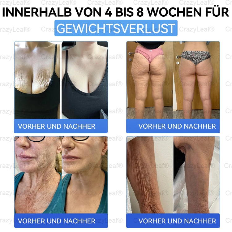 "Letzte 30 Min: 1 kaufen, 1 gratis!" CrazyLeaf® Nano-Microneedle-Pflaster mit SMGT-GLP-1, Matrixyl 3000, Botox & Kollagenpeptiden – Wirkt gegen Übergewicht, schlaffe Haut, Herzprobleme, Diabetes, Schlafapnoe, Gelenkbeschwerden u.v.m. 1