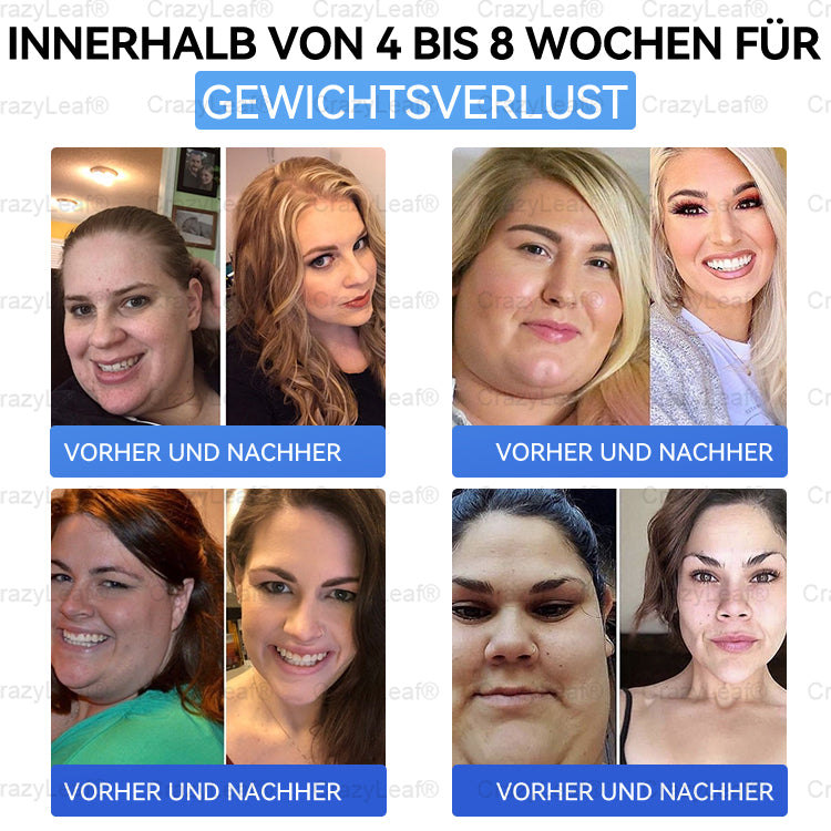 "Letzte 30 Min: 1 kaufen, 1 gratis!" CrazyLeaf® Nano-Microneedle-Pflaster mit SMGT-GLP-1, Matrixyl 3000, Botox & Kollagenpeptiden – Wirkt gegen Übergewicht, schlaffe Haut, Herzprobleme, Diabetes, Schlafapnoe, Gelenkbeschwerden u.v.m. 1