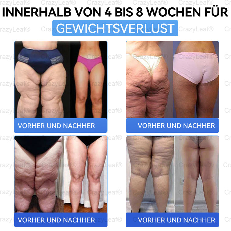 "Letzte 30 Min: 1 kaufen, 1 gratis!" CrazyLeaf® Nano-Microneedle-Pflaster mit SMGT-GLP-1, Matrixyl 3000, Botox & Kollagenpeptiden – Wirkt gegen Übergewicht, schlaffe Haut, Herzprobleme, Diabetes, Schlafapnoe, Gelenkbeschwerden u.v.m. 1