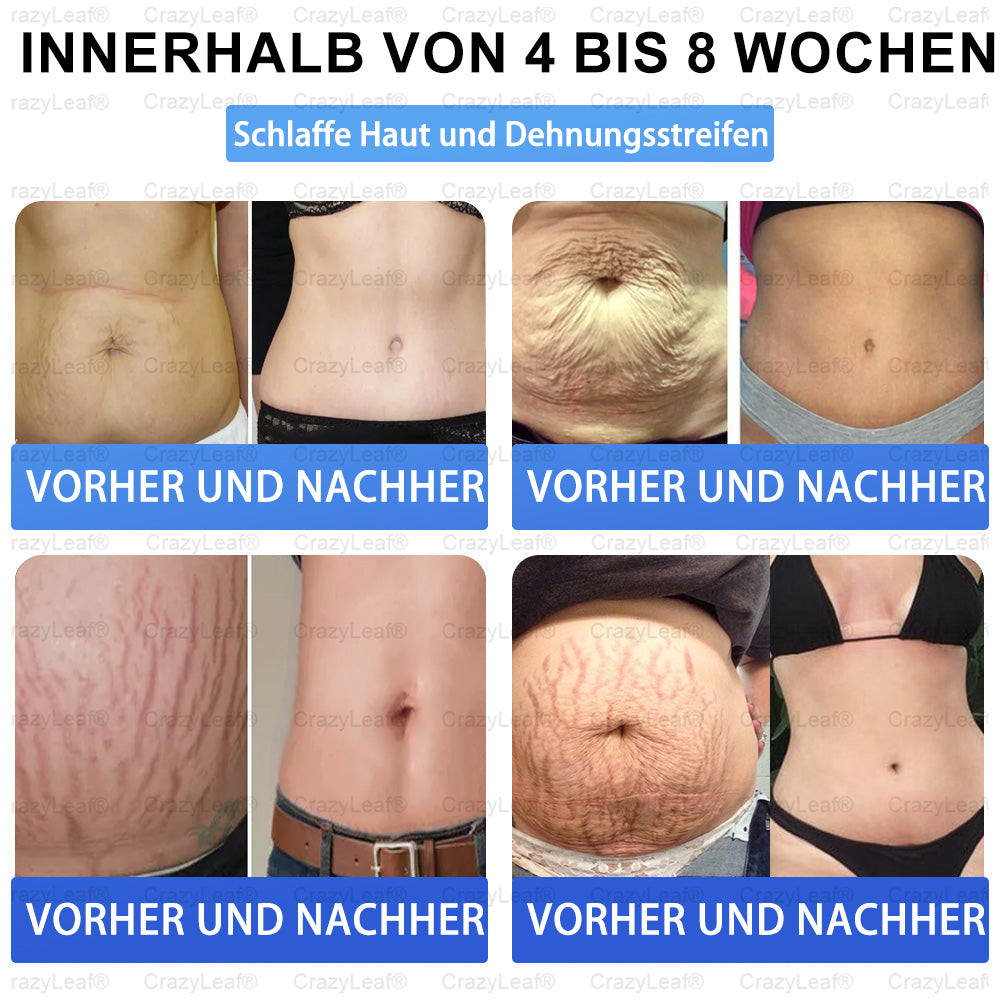 "Letzte 30 Min: 1 kaufen, 1 gratis!" CrazyLeaf® Nano-Microneedle-Pflaster mit SMGT-GLP-1, Matrixyl 3000, Botox & Kollagenpeptiden – Wirkt gegen Übergewicht, schlaffe Haut, Herzprobleme, Diabetes, Schlafapnoe, Gelenkbeschwerden u.v.m. 1