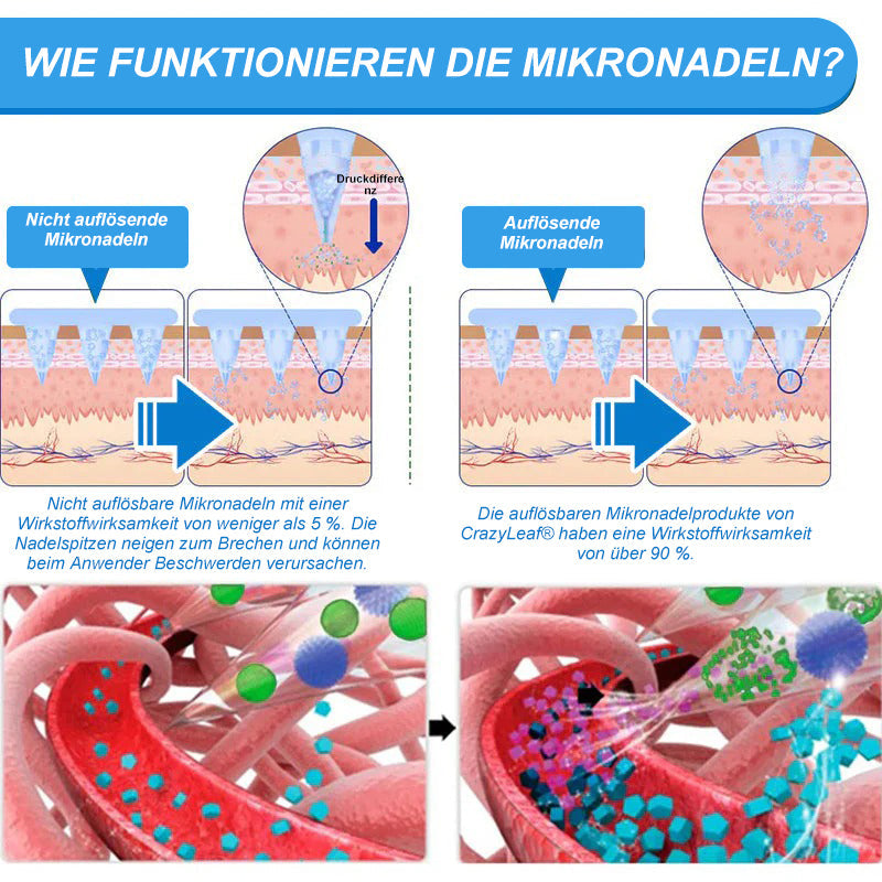 "Letzte 30 Min: 1 kaufen, 1 gratis!" CrazyLeaf® Nano-Microneedle-Pflaster mit SMGT-GLP-1, Matrixyl 3000, Botox & Kollagenpeptiden – Wirkt gegen Übergewicht, schlaffe Haut, Herzprobleme, Diabetes, Schlafapnoe, Gelenkbeschwerden u.v.m. 1